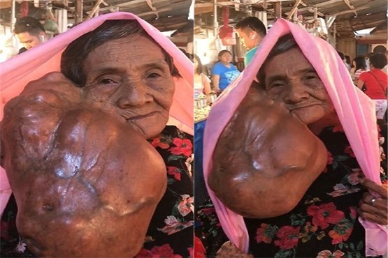 تومور عجیب در صورت زن فیلیپینی +عکس