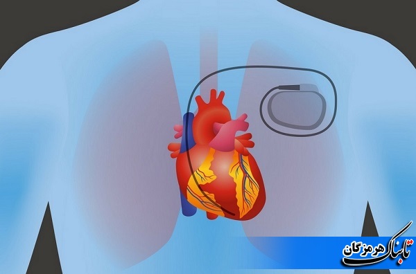 خدمات باطری قلب در هرمزگان انجام می شود